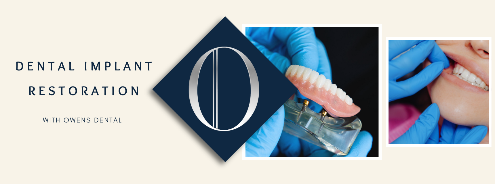 Dental implant restoration at Owens Dental