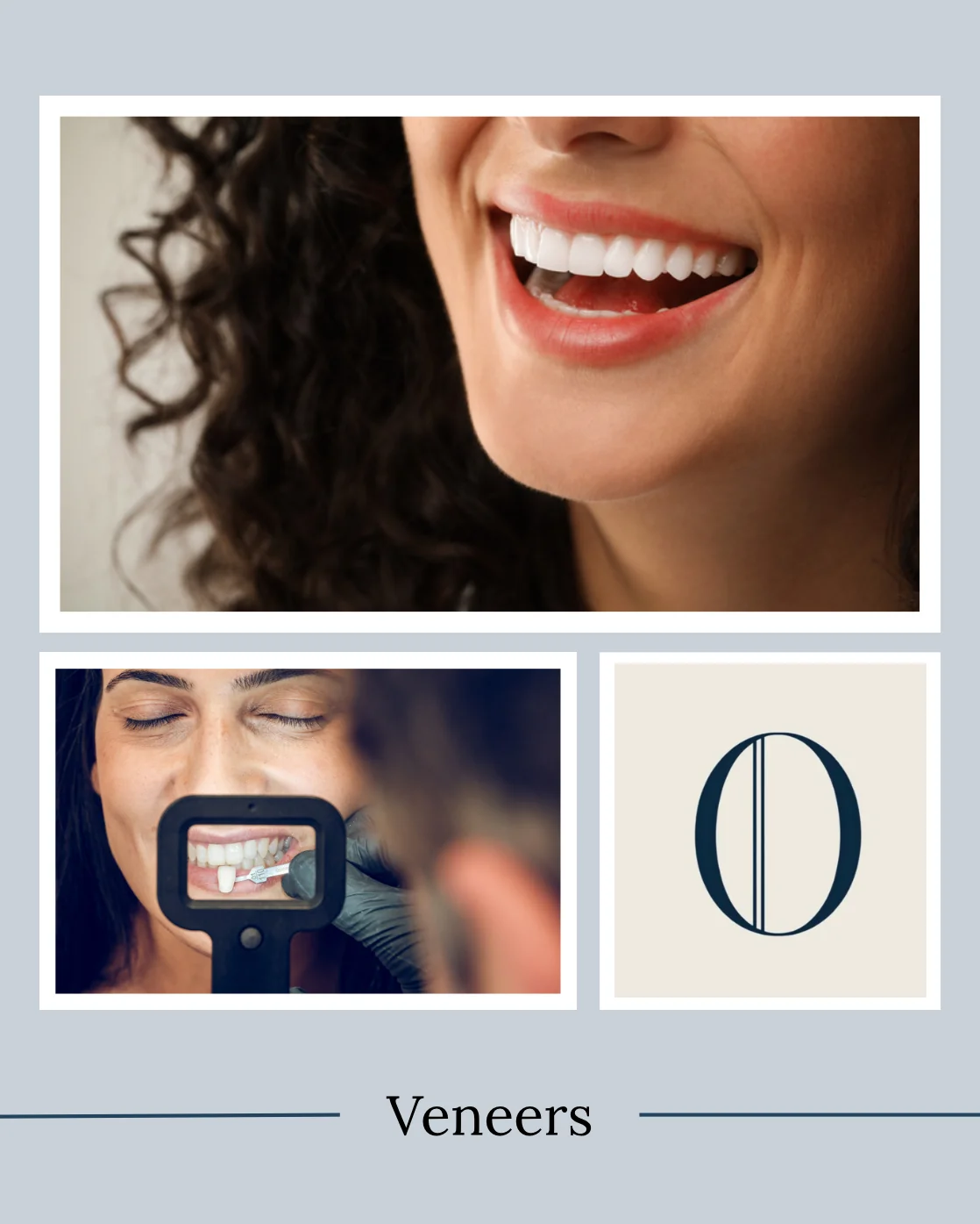 Close-up of a smile enhanced with dental veneers
