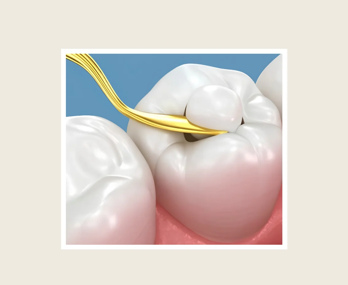 Dental team performing a composite resin restoration